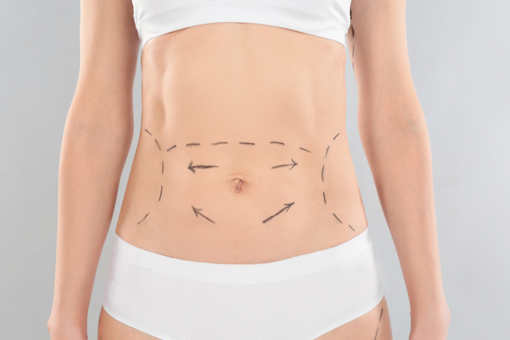 The Abdominoplasty: Tummy Tuck Prices, Candidates, Recovery, and Risks